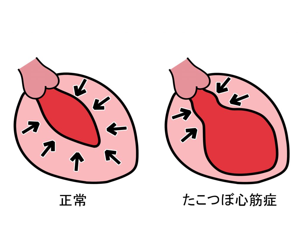 ストレスが発症要因になる「たこつぼ心筋症」とは